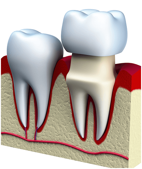 dental crown