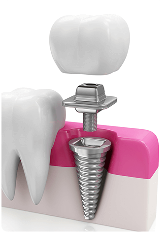 implant procedure example