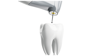 root canal example