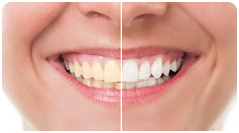 before and after whitening