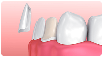 veneers